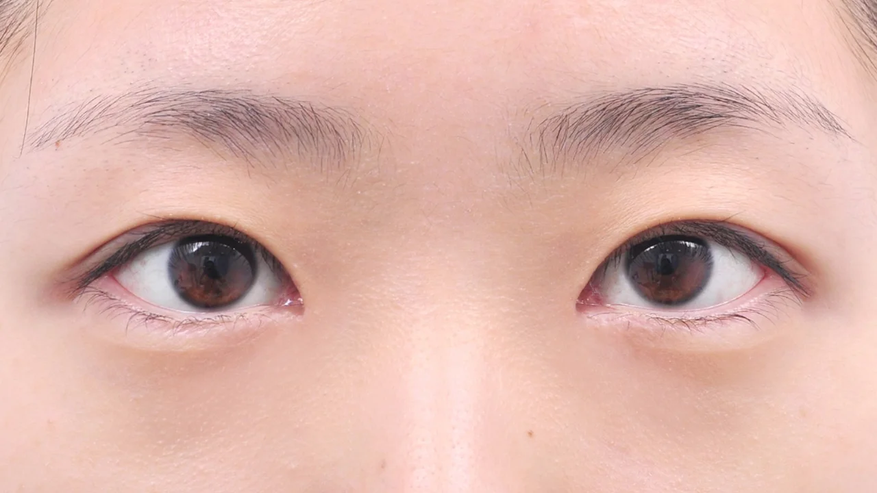 術後1ヶ月の目もと(症例写真)