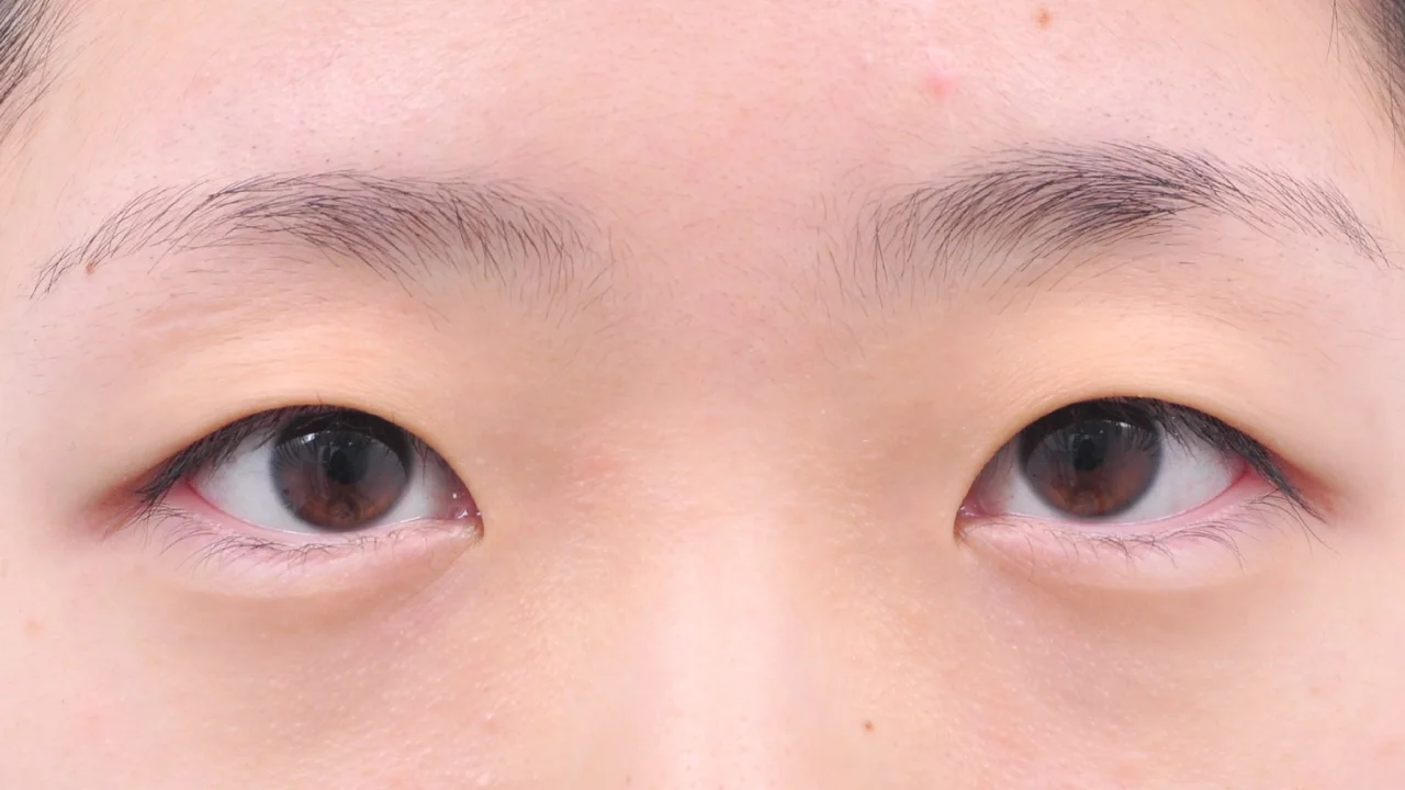術前の目もと(症例写真)