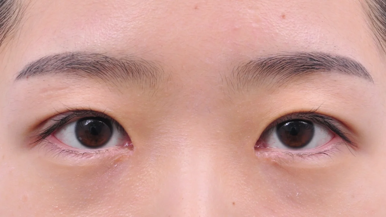 術後14日の目もと(症例写真)