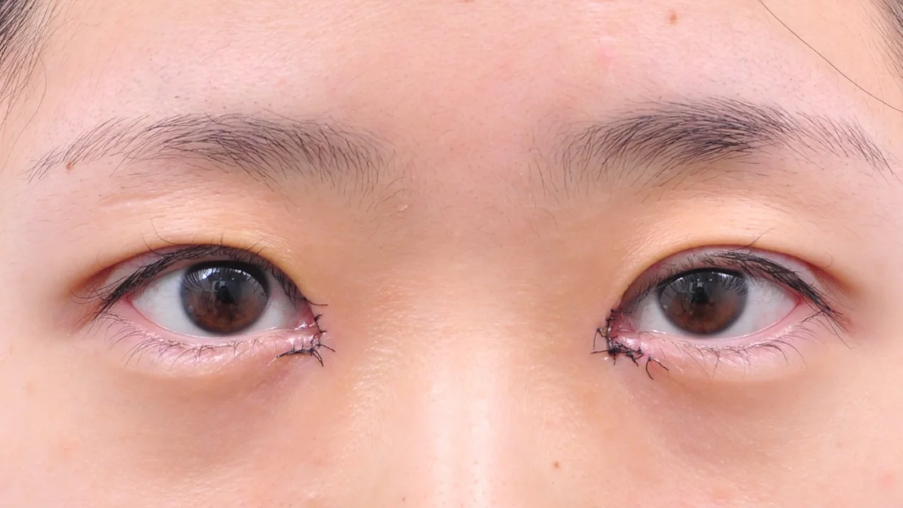 術後2日の目もと(症例写真)
