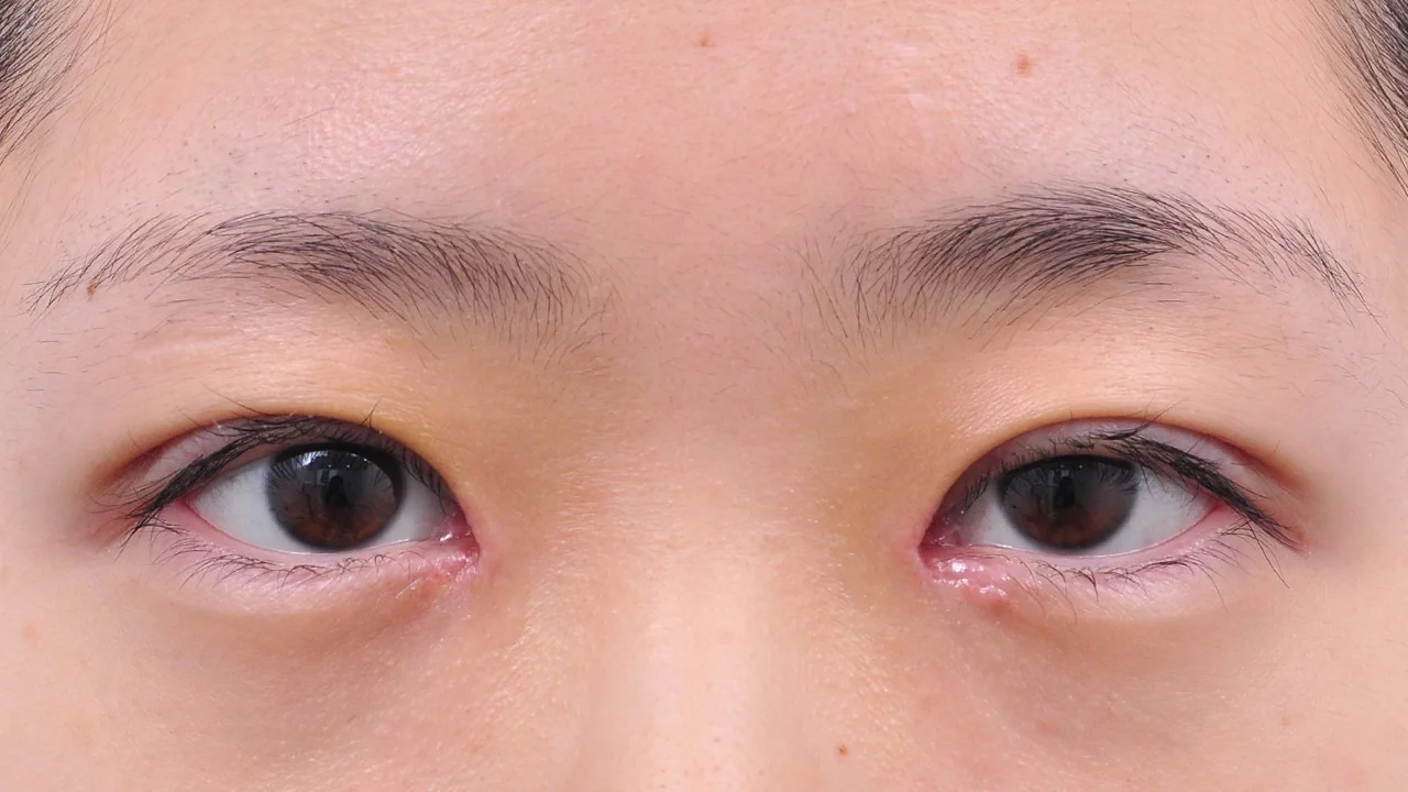 術後6日の目もと(症例写真)