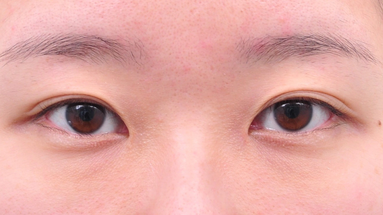 グレートゥイム®+眼瞼内反症(逆さまつげ)矯正 施術前(症例写真)|OLO美容外科