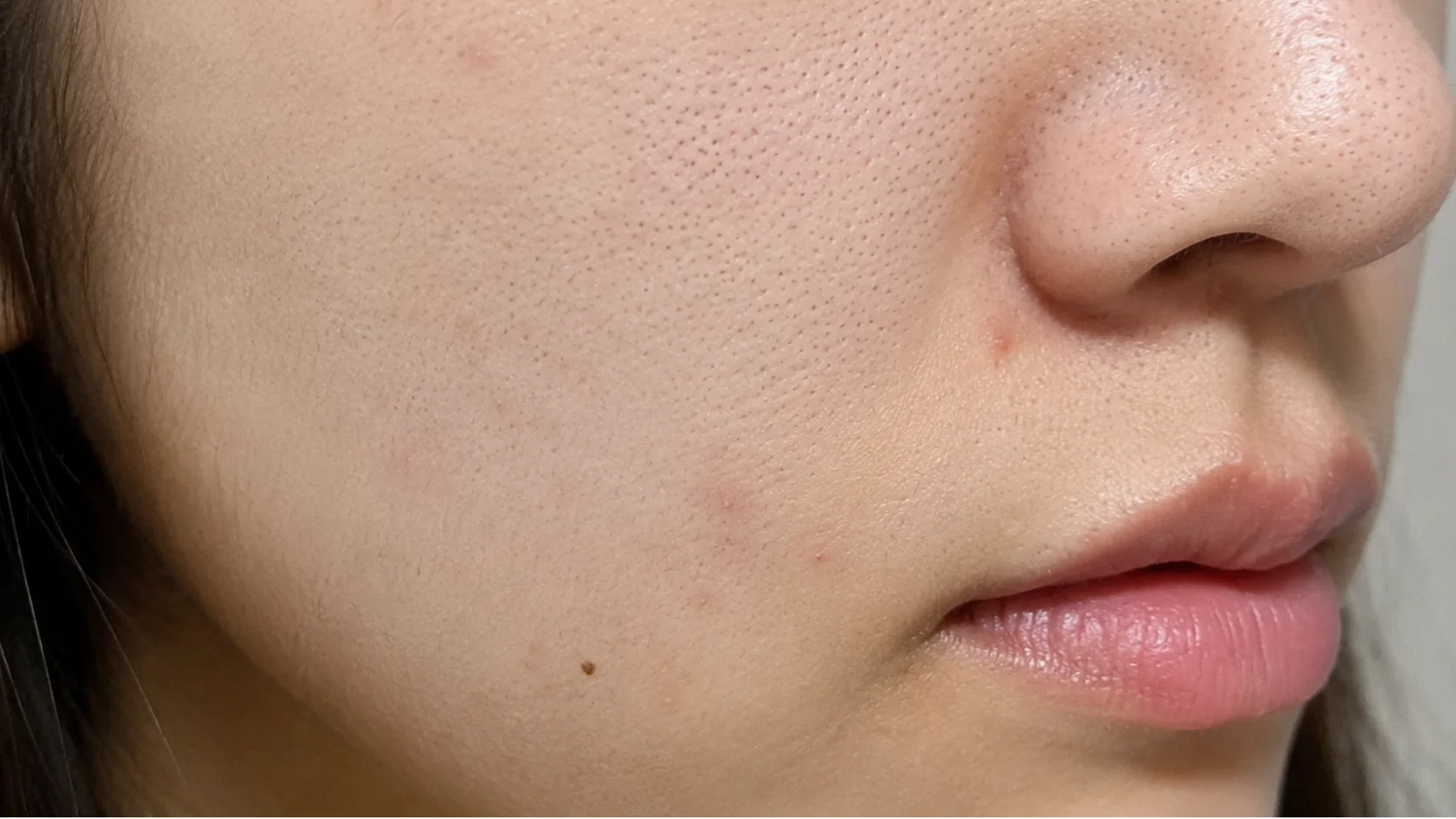 症例A スキンボトックス美肌セット 施術前の肌(臨床写真)|OLO美容外科